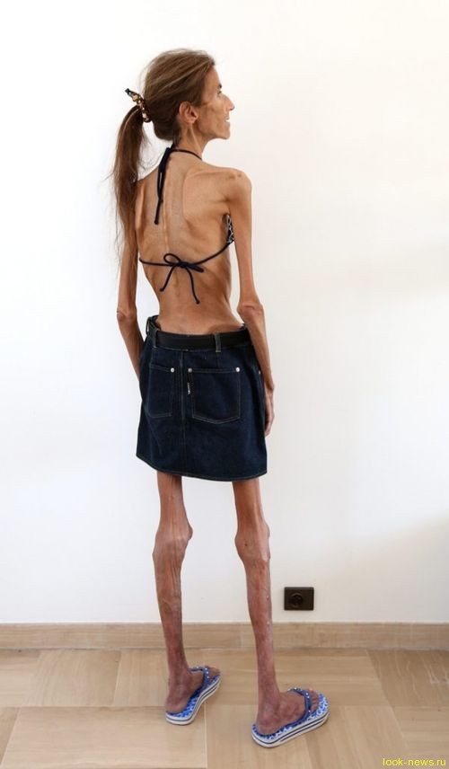 Валерия Левитина: самая худая женщина в мире борется против анорексии